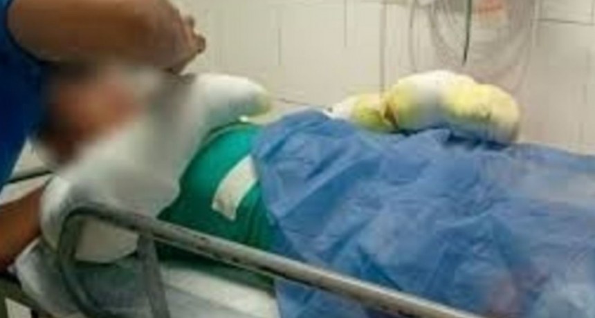  Un adolescente está con el 60% del cuerpo quemado después de que le explotó su celular