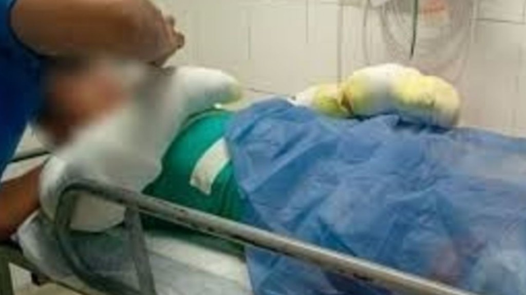  Un adolescente está con el 60% del cuerpo quemado después de que le explotó su celular